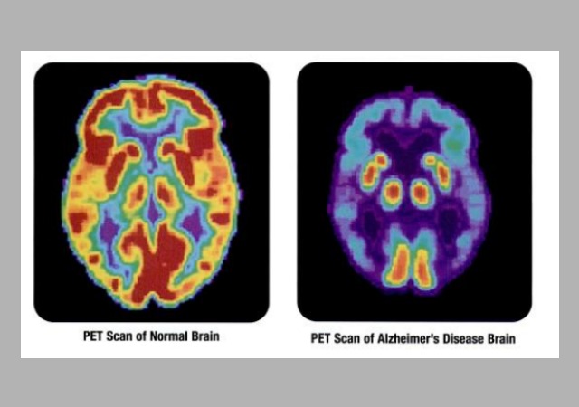 Alzheimer's | treatment | advancement | cure